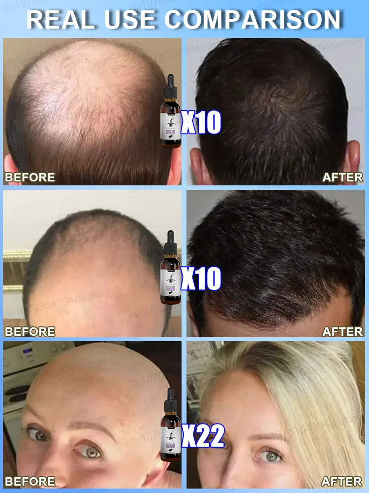 Óleo de Essência de Crescimento Capilar para Homens e Mulheres, Calvície Eficaz, Reparação Rápida, Tratamento, Anti-Hereditário, Seborreica, Alopecia Loss