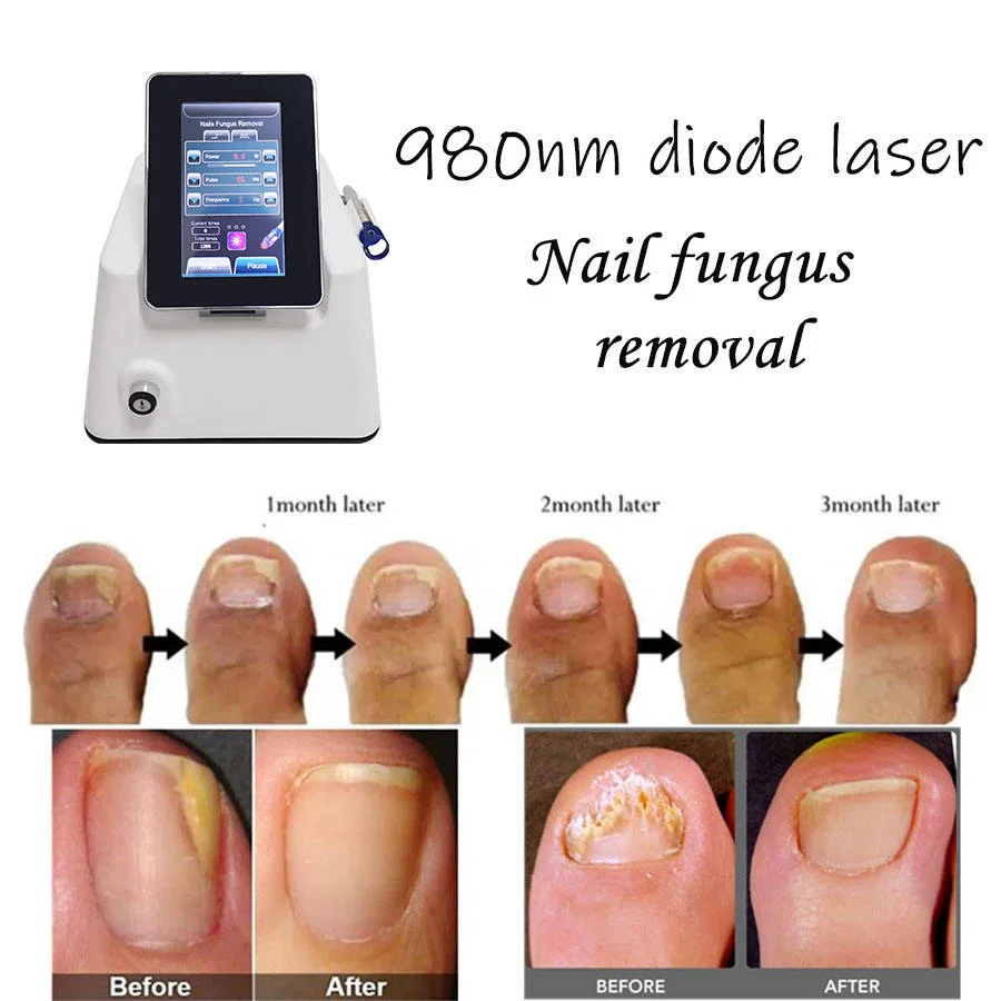 BH2-N-M05 Desktop 980nm 30W Diode Laser Nail Fungus Treatment Machine for Feet & Hands Gray Nails Removal