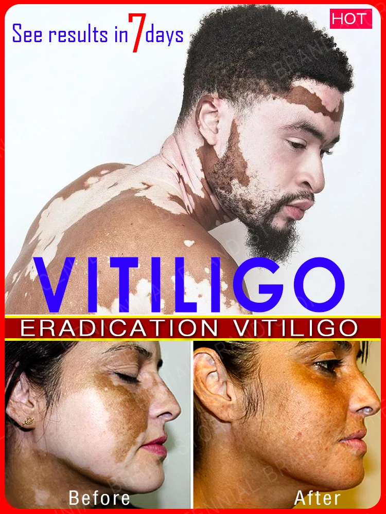 

mitigate vitiligo