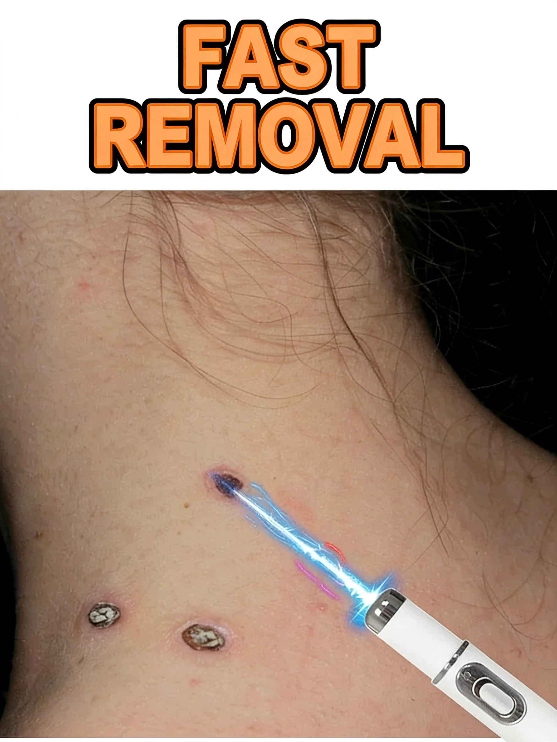 

Latest upgraded blue light pen, best-selling wart care