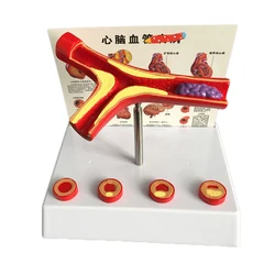 50 Times Enlarged Human Vessel Atherosclerosis Vascular Model Lab Supplies