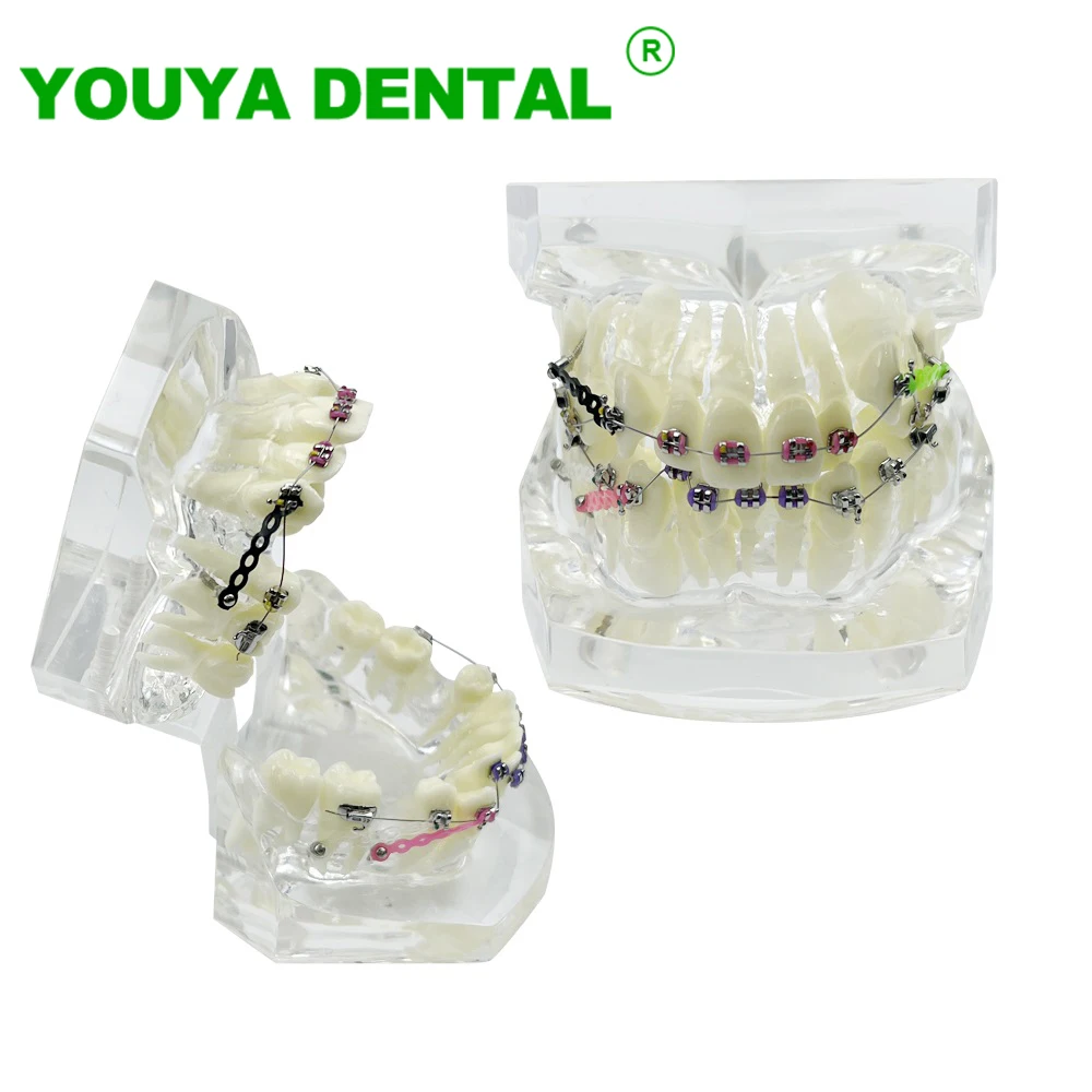 

Dental Orthodontic Model Transparent Teeth Malocclusion Model With Brackets Archwire Buccal Tube For Patient Communication New