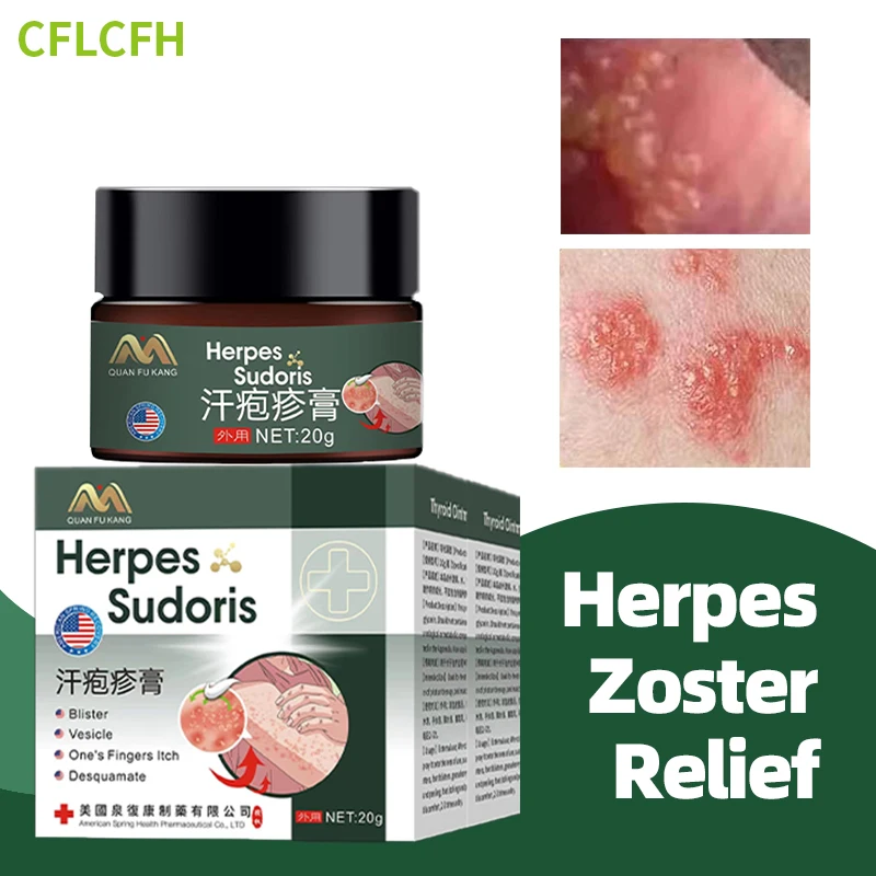 American Herpes Zoster Treatment Cream Shingles Cure Skin Medicine Snake Sore Red Dot Blister Herpes Simplex Ointment 20g