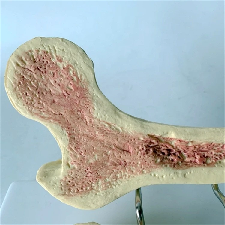 Medical Human Femur Anatomy Internal Structure Model Osteoporosis School Bone