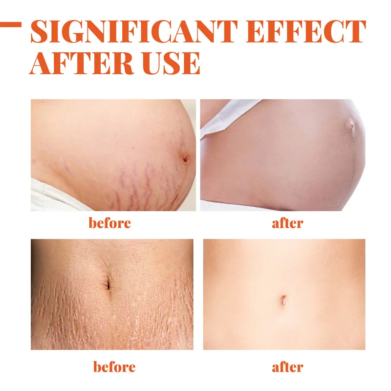 Stretch Mark Vanishing Cream Repair Anti-Wrinkle Anti-Aging Pregnant Women Stretch Marks Treatment Cream Vitamin E Skin Care 50g