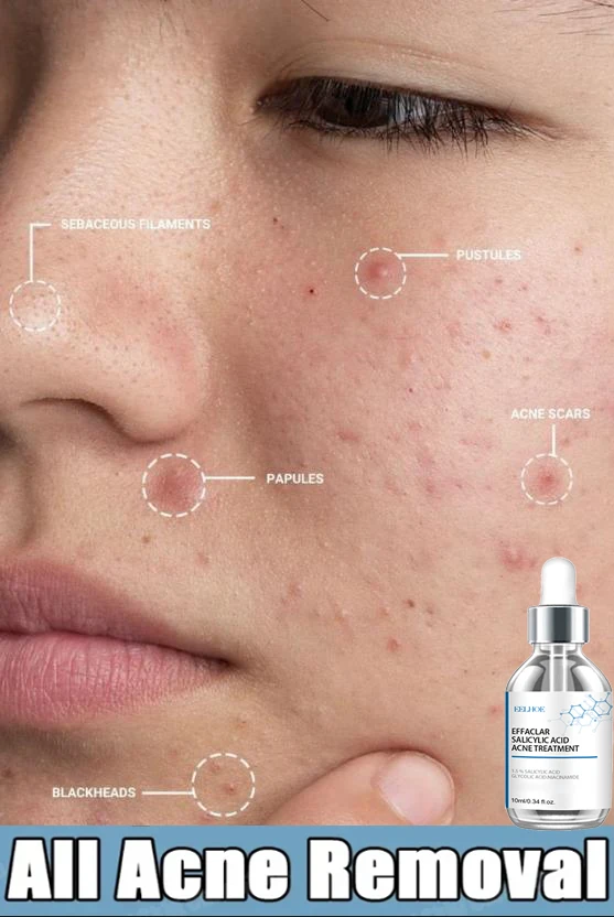 2026 Salicylic Acid  Solution Essence Shrink pores and Acne Spot Removing Shrink Pores Oil-Control Brighten Face Skin Makeup