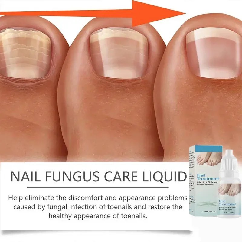 Fungal Nail Removal 10ML Fungal Nail Treatment Oil Foot Repair Essence Toe Nail Fungus Removal Gel Anti Infection Cream4363