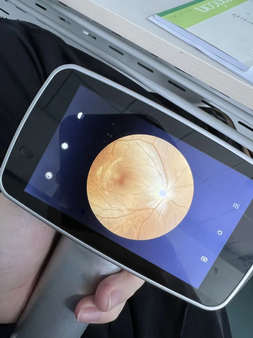 ophthalmology equipment Hand-held retina fundus photography Camera retinal camera