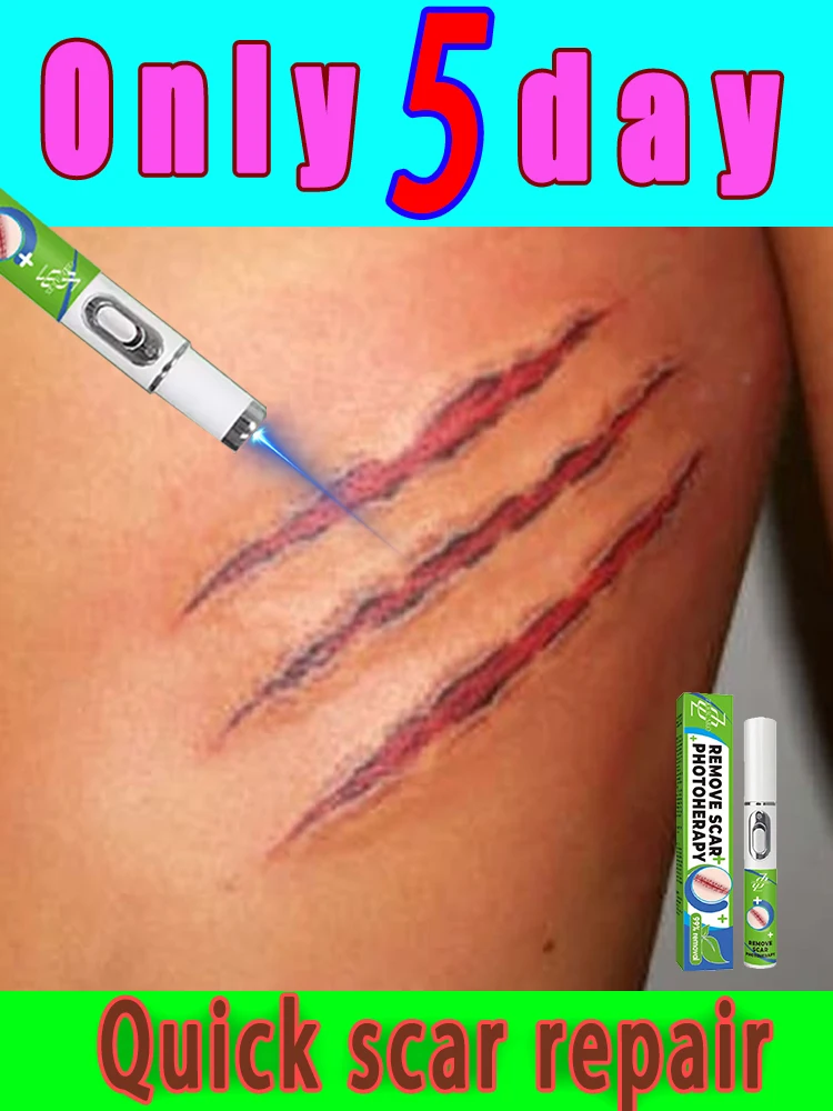 

Rᴇᴍᴏᴠᴇ ғᴀᴄɪᴀʟ sᴄᴀʀs, ʜᴀɴᴅ sᴄᴀʀs, ʟᴇɢ sᴄᴀʀs, sᴇᴄᴏɴᴅ ɢᴇɴᴇʀᴀᴛɪᴏɴ sᴄᴀʀ ʀᴇᴍᴏᴠᴀʟ ʟᴀsᴇʀ ᴘᴇɴ