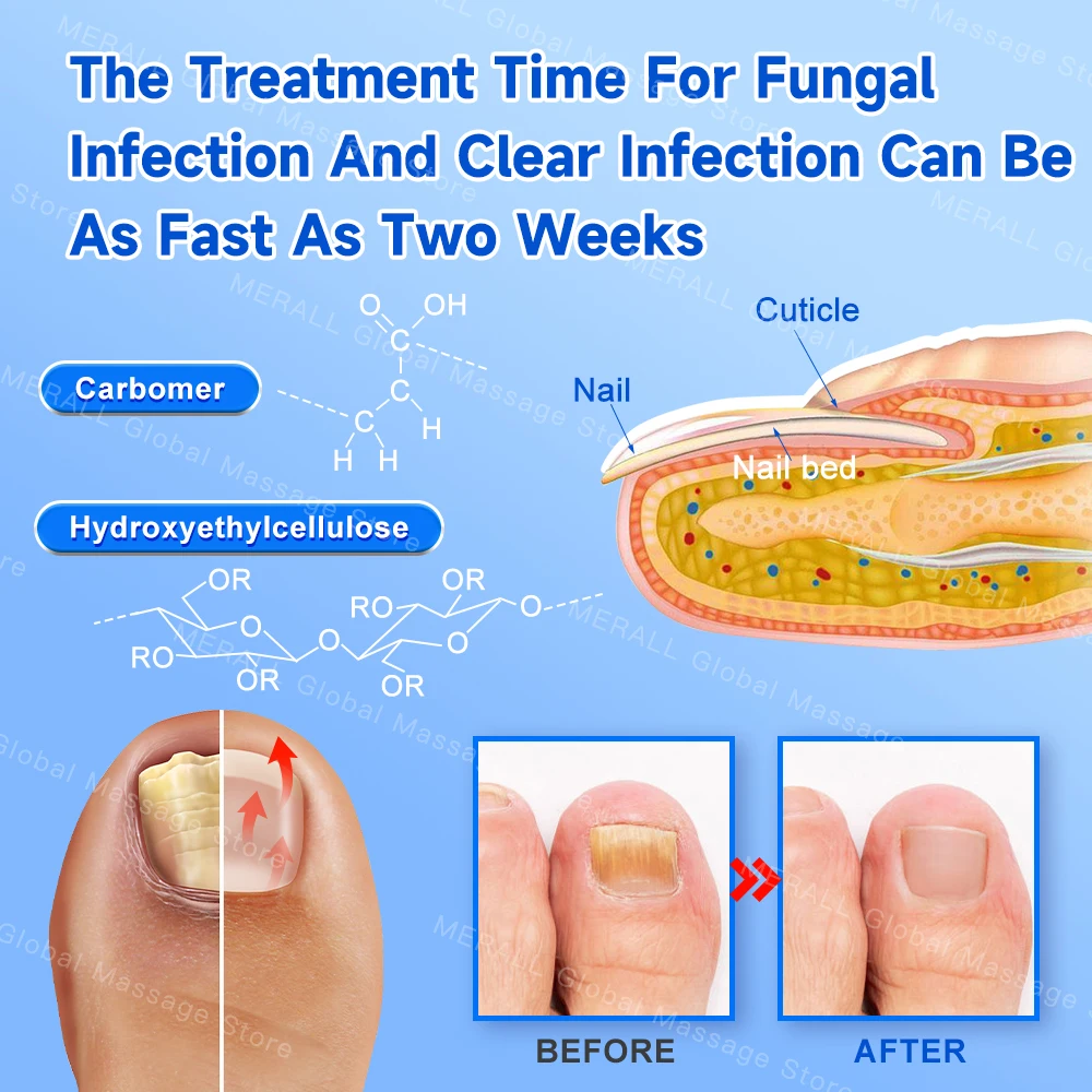 Appareil de traitement fongique des ongles, réparation rapide des champignons, réparation de l\'onychomycose, élimination des ongles, soins des