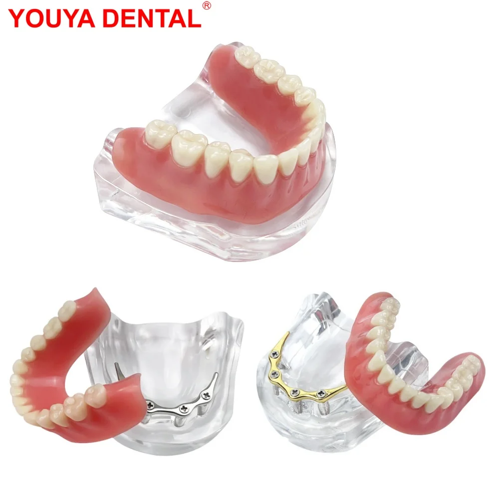 

Mandible Implant Dental Teeth Teaching Model Implant Restoration Bridge Removable Submaxillary Overdenture Model For Studying