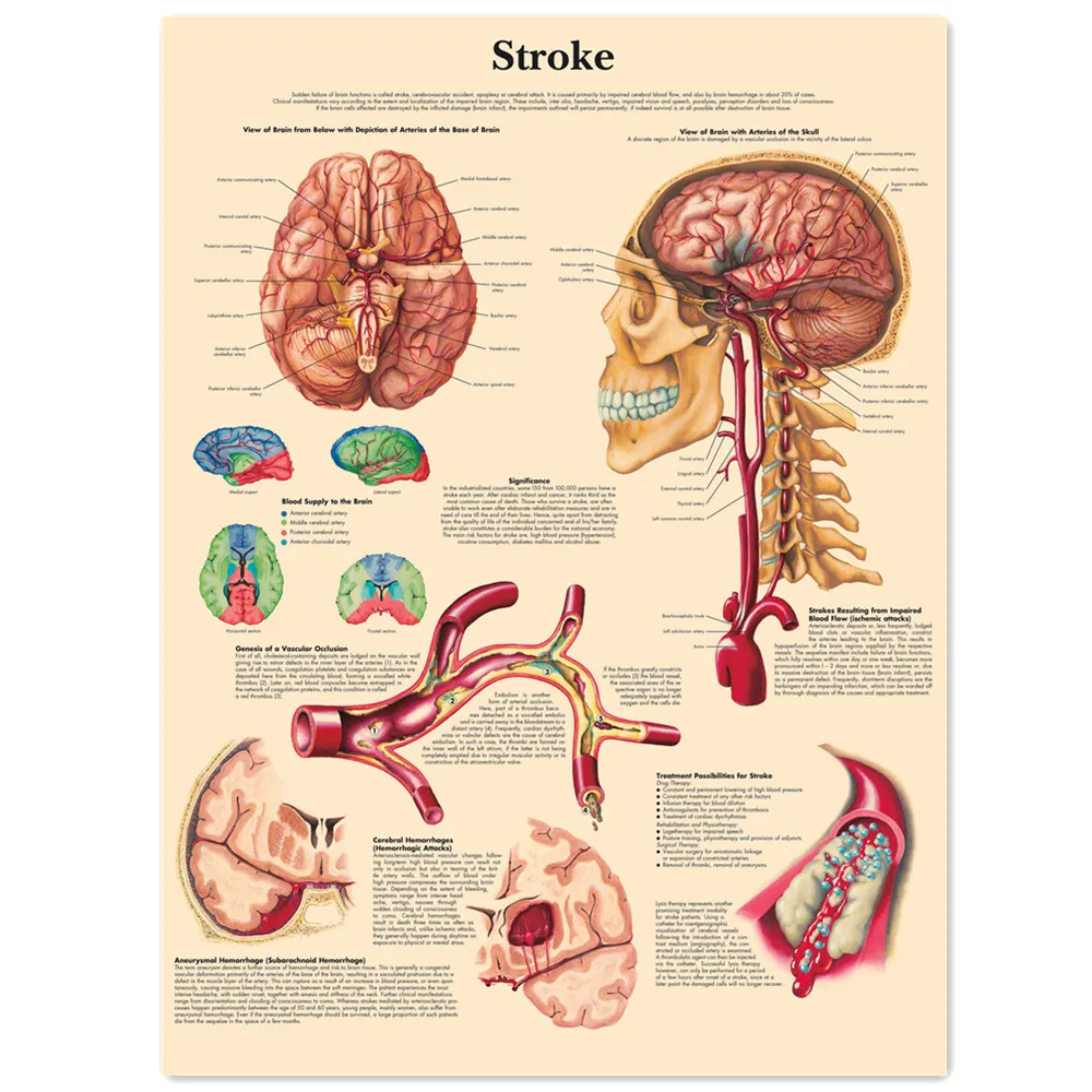 Stroke Posters and Prints Human Anatomy Wall Art Vintage Kraft Paper Painting Wall Chart Hospital Clinic Room Home Decor Sticker