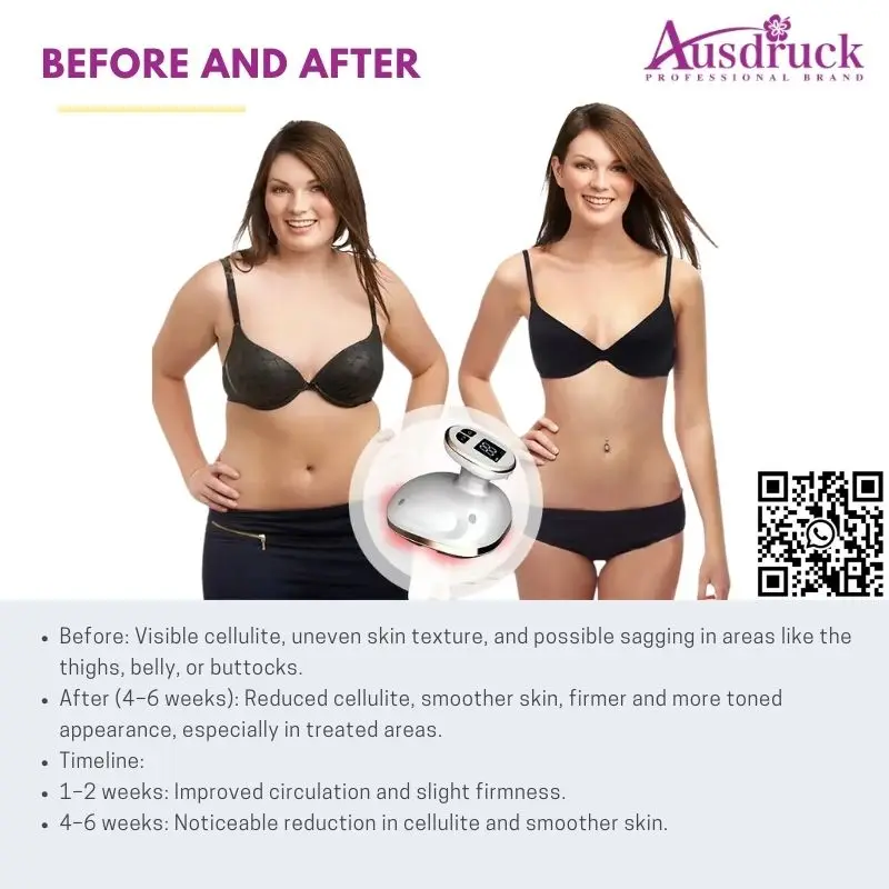 آلة تشكيل الجسم والتخسيس المضادة للسيلوليت للبطن والخصر والساق والذراع وتقليل الدهون والعناية بالبشرة مع العلاج المكركرنت