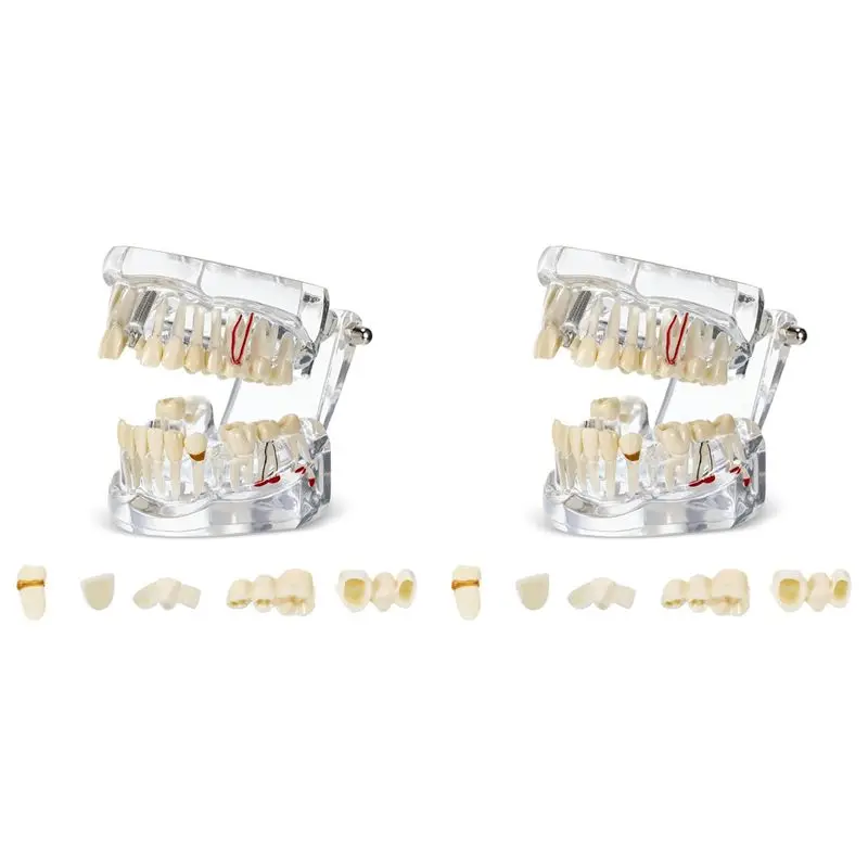 

2X модель зубов с заболеваниями Typodonts, модель зубов с имплантатом со съемными зубами, стандартная демонстрация зубов стоматолога