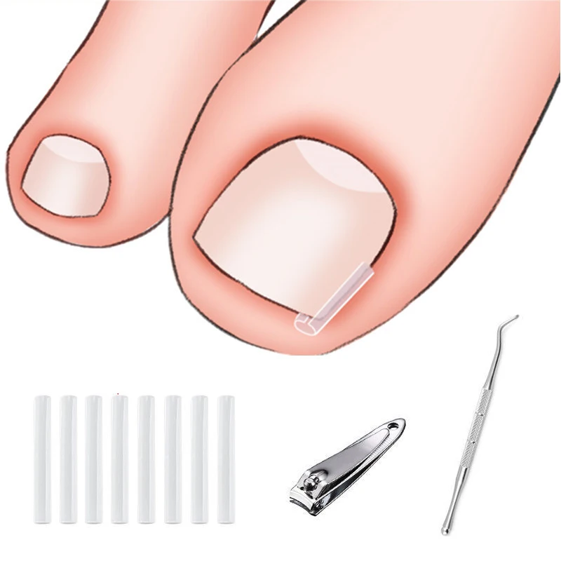 1Set Ingrown Toenail Correction Tool Ingrown Toe Nail Treatment Elastic Patch Sticker Straightening Clip Brace Pedicure Tool