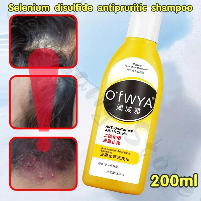 

Selenium Sulfide Antipruritic Shampoo Refreshing Oil Control Deep Cleansing to Remove Hair Follicles from Scalp Pimples 200ml