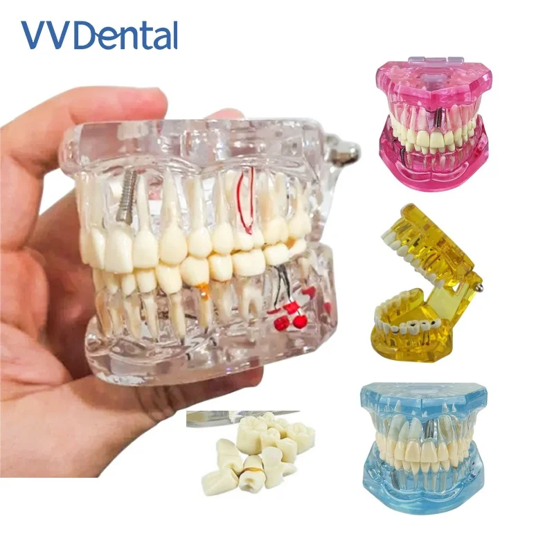 

Removable Teeth Model Implant Disease Dentist Studying New Dental Model Teeth Implant Restoration Bridge Teaching Demonstration