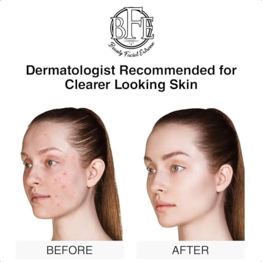 As almofadas para tratamento de acne eliminam fuga estatística, poros oleosos entupidos. Espinha clara cravo cravo manchas escuras imp pele t