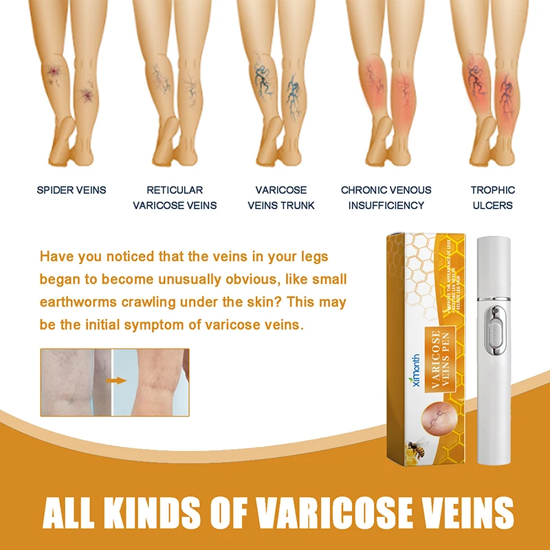 Lampshade Therapy Varicose Veins Legs Effective Relief Of Dilated Vasculitis Phlebitis Health Improved For Blood Circulation