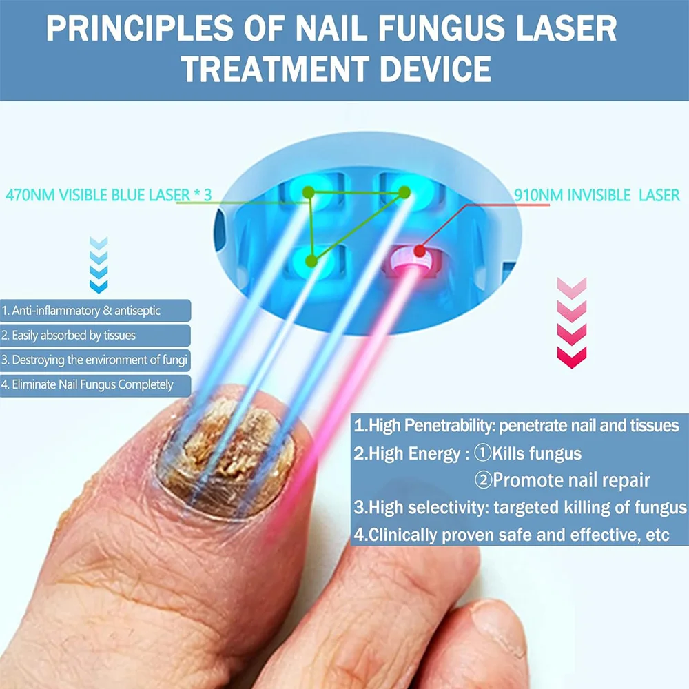 JUSTLANG Rechargeable Fungus Grey Nail Treatment Device Portable Onychomycosis Treatment Laser Therapy Relieve Ingrown Foot Care