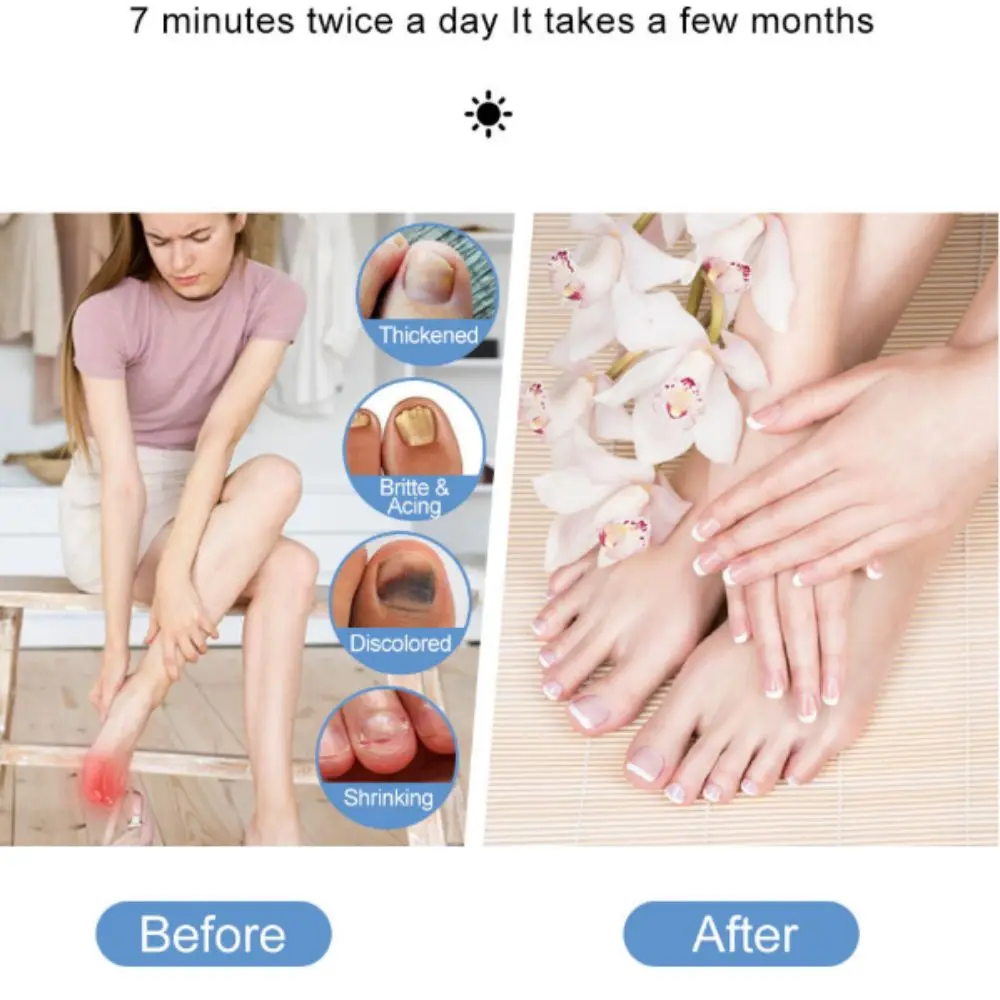 High Definition Display Nail Fungus Care Lamp Soft LED UV Light Lightweight Compact Nail Repair Tool USB Rechargeable