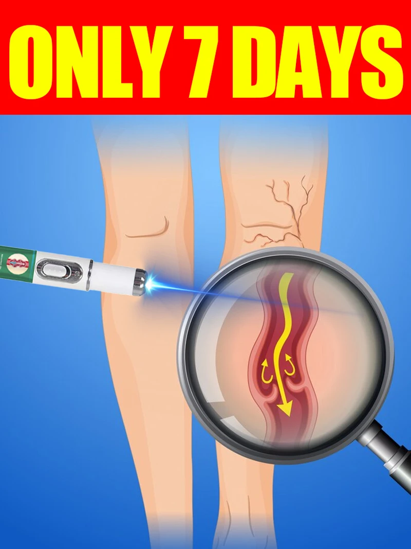 Generation-3 Laser Says Goodbye To Varicose Veins In 7 Days