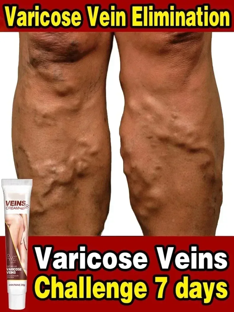 Varicose Vein Relief Paste Improve Blood Circulations Spider Varicose Vein For Tired Heavy Legs Fast Relief New