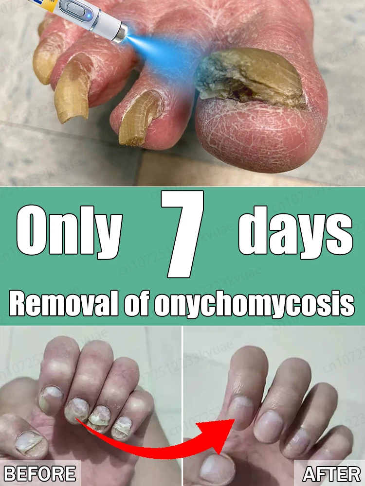

Say goodbye to onychomycosis with scientific methods, safe and without recurrence