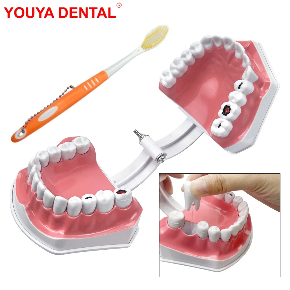 1pcs Dental Caries Model Plastic Dental Model Teeth Brushing Model Dentistry Teeth Model With Toothbrush For Studying Teaching
