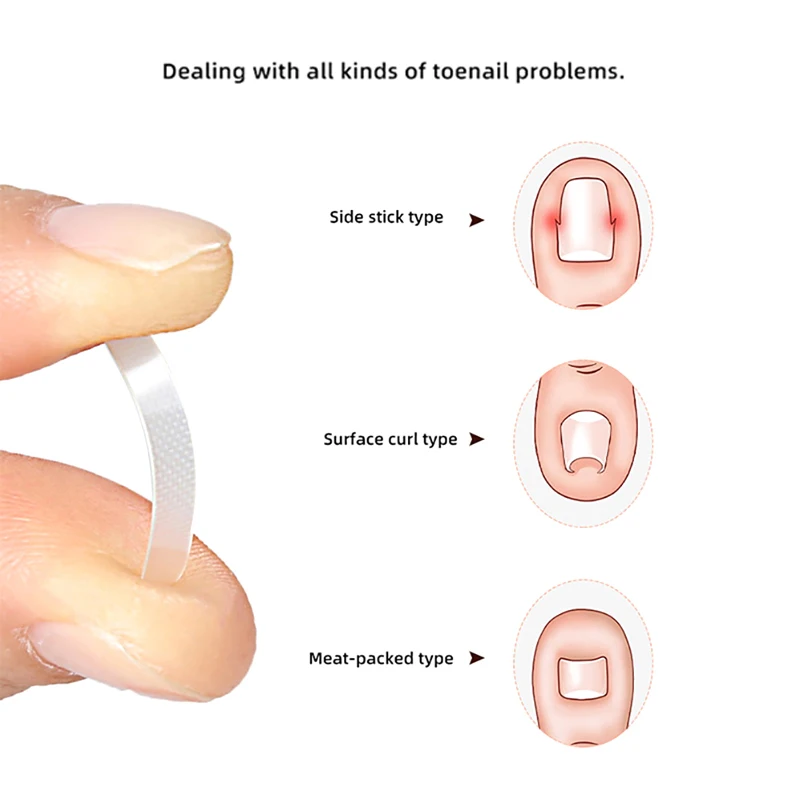 10 قطعة نام تو مسمار العلاج نام أظافر تصحيح أداة مطاطا التصحيح ملصق استقامة كليب هدفين أدوات باديكير #6