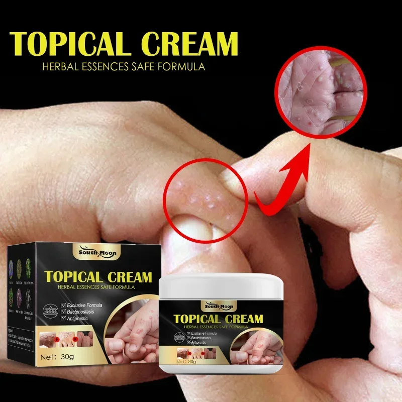 Professional Hand foot antipruritic ointment skin dry Treatment mosquito bite Anti itch topical cream Herbal Plaster Skin Care