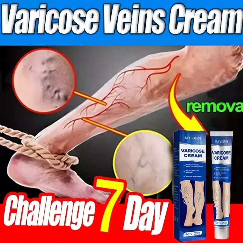 Pomada para venas varicosas, crema efectiva para aliviar la Vasculitis, flebitis, tratamiento del dolor de araña, cuidado de los pies