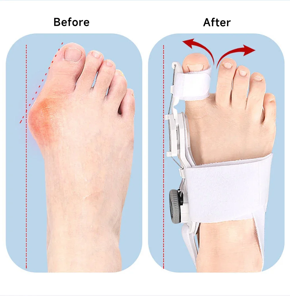 Toe Separator Hallux Valgus Bunion Corrector Orthotics Feet Bone Thumb Adjuster Correction Pedicure Sock Straightener