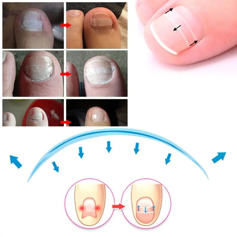 E1YE 10 ชิ้นคุด Toenails เทปยืดโค้งคลิปรั้งแพทช์เล็บ