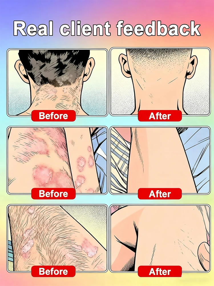 Restaura la piel sana, ss, 