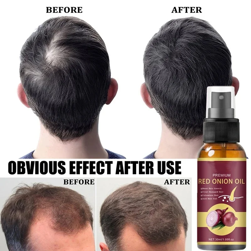 Spray de soro do crescimento do cabelo para homens e mulheres, reparo do cabelo Nourish, rebrota raiz, anti perda de cabelo, tratamento poderoso, essência, cuidado do cabelo