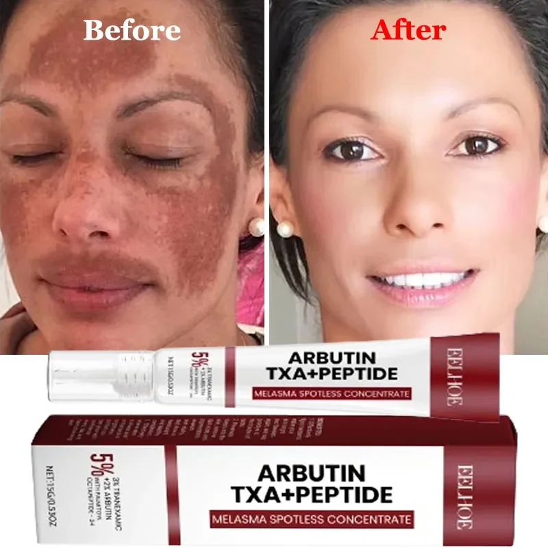 

Powerful Spot-Removing Whiten Cream Brighten Skin Fast Eliminates Melanin Pigmentation Melasma Dark Spots Korean Skin Care