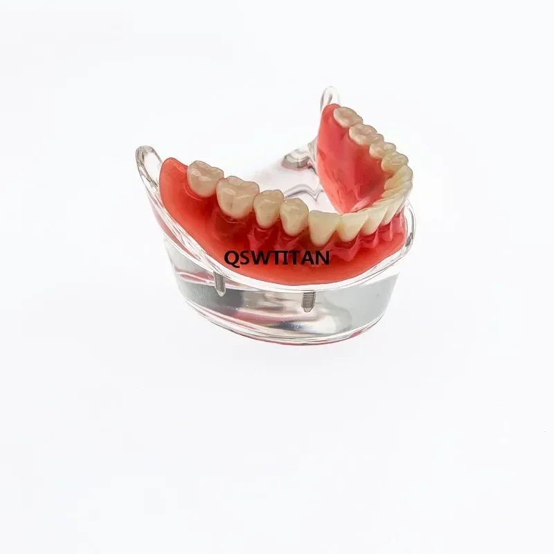 Dental Teeth Model With 4 Implant Overdenture Lower jaw Teeth Study teaching model