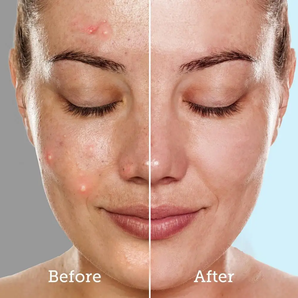 Strumento per la pulizia dei punti neri Cura della pelle Estrattore di acne Strumento per la pulizia profonda Spatola per la pulizia dei pori in acciaio inossidabile Raschietto per il viso per le donne