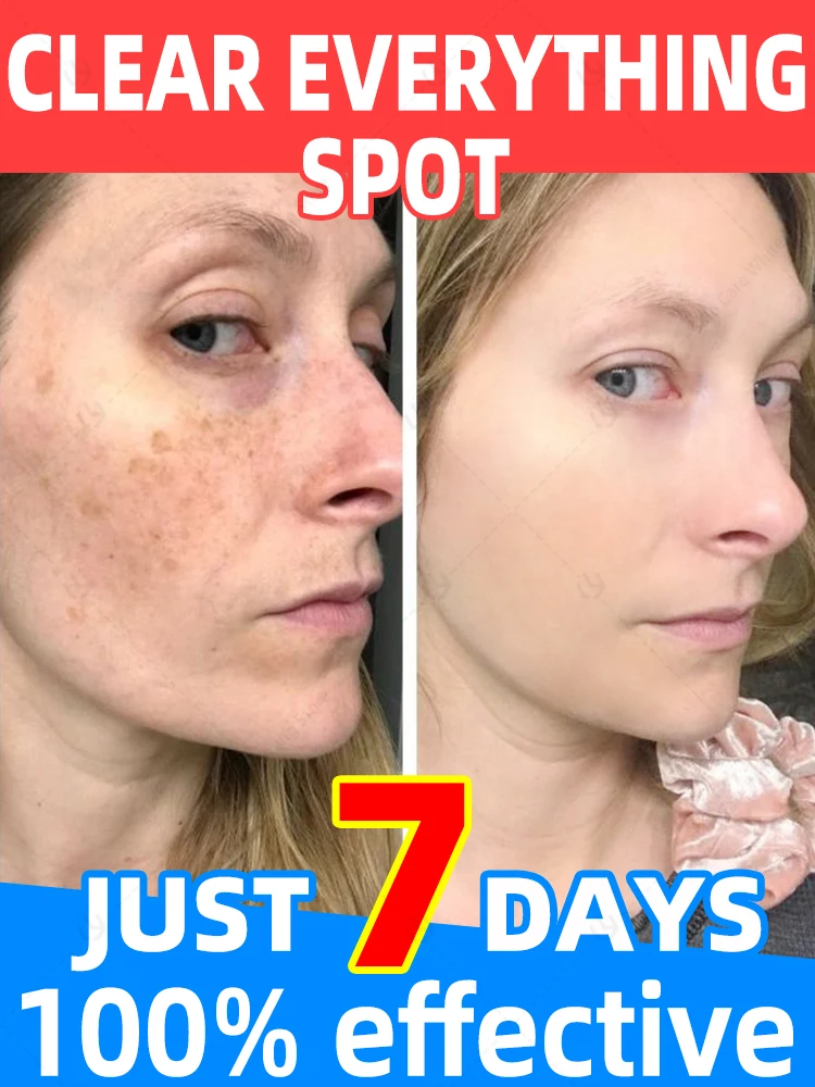 

Dark Spots Remover Cream, For Armpit,Elbows, Legs, Age Sun Spot Freckle Remove