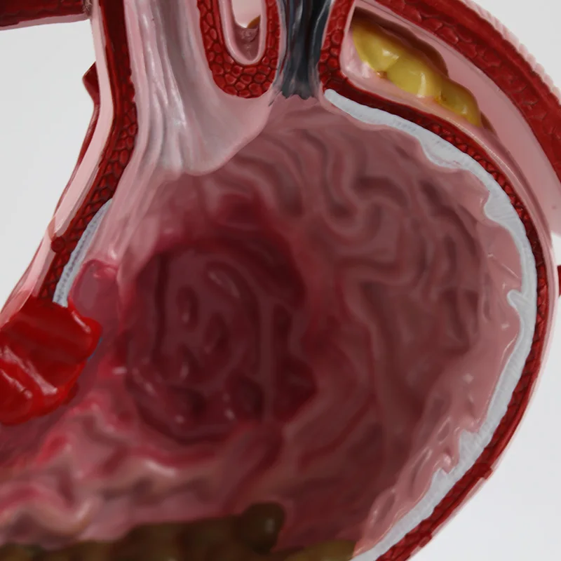 Diseased Stomach Model with Diaphragm Demonstration Anatomy Model Pathological Stomach Model