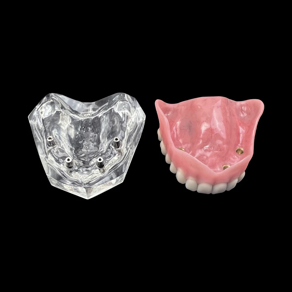 Upper/Lower jaw With 4 Implants Dental Mandibular Maxillary Teeth Model Demo Overdenture Typodont Teaching Research Clinic