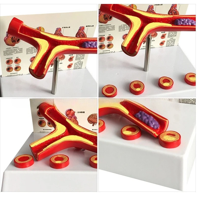 Vascular blockage model, vascular pathological anatomy model