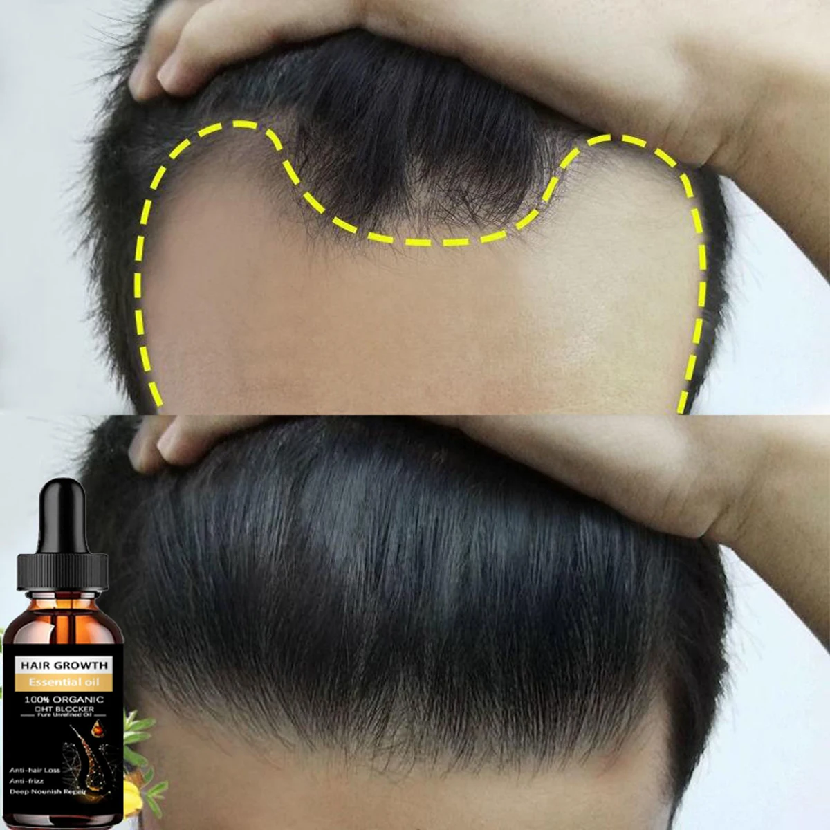 Hair Spray GROWER Product  Anti-hair Loss Essential Oil -Growth Serum Hair Growth for Men