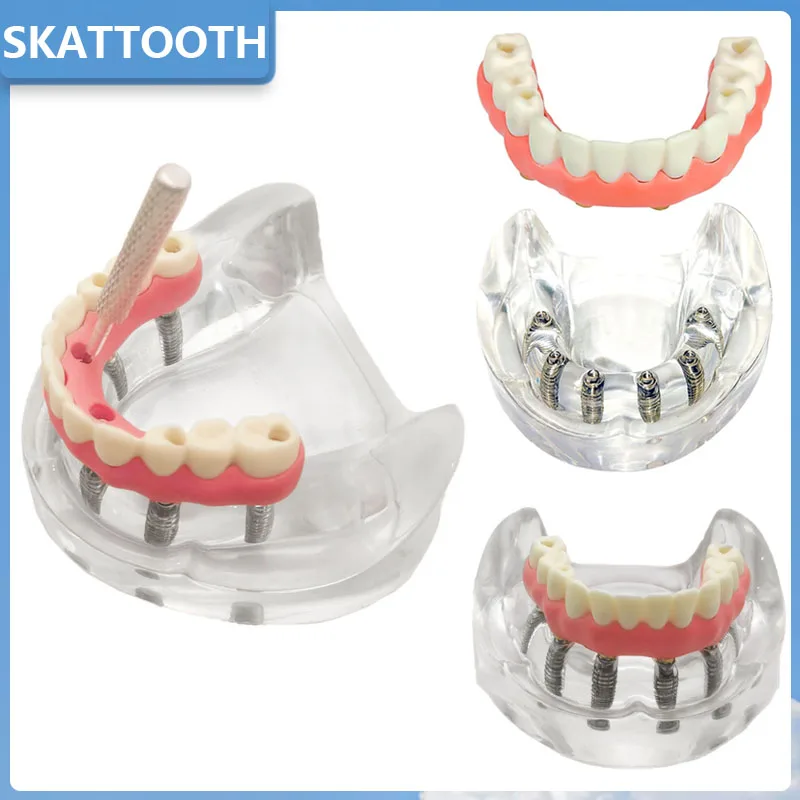 

Dental Implant Model with Implant Overdenture Inferior Lower Tooth Implant Removable Model for Dentist Teaching Studying Demo