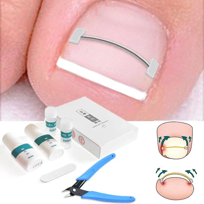 Ingrown Toenail Corrector Tools Pedicure Recover Embed Toe Nail Treatment Professional Ingrown Toenail Correction Foot CareTool