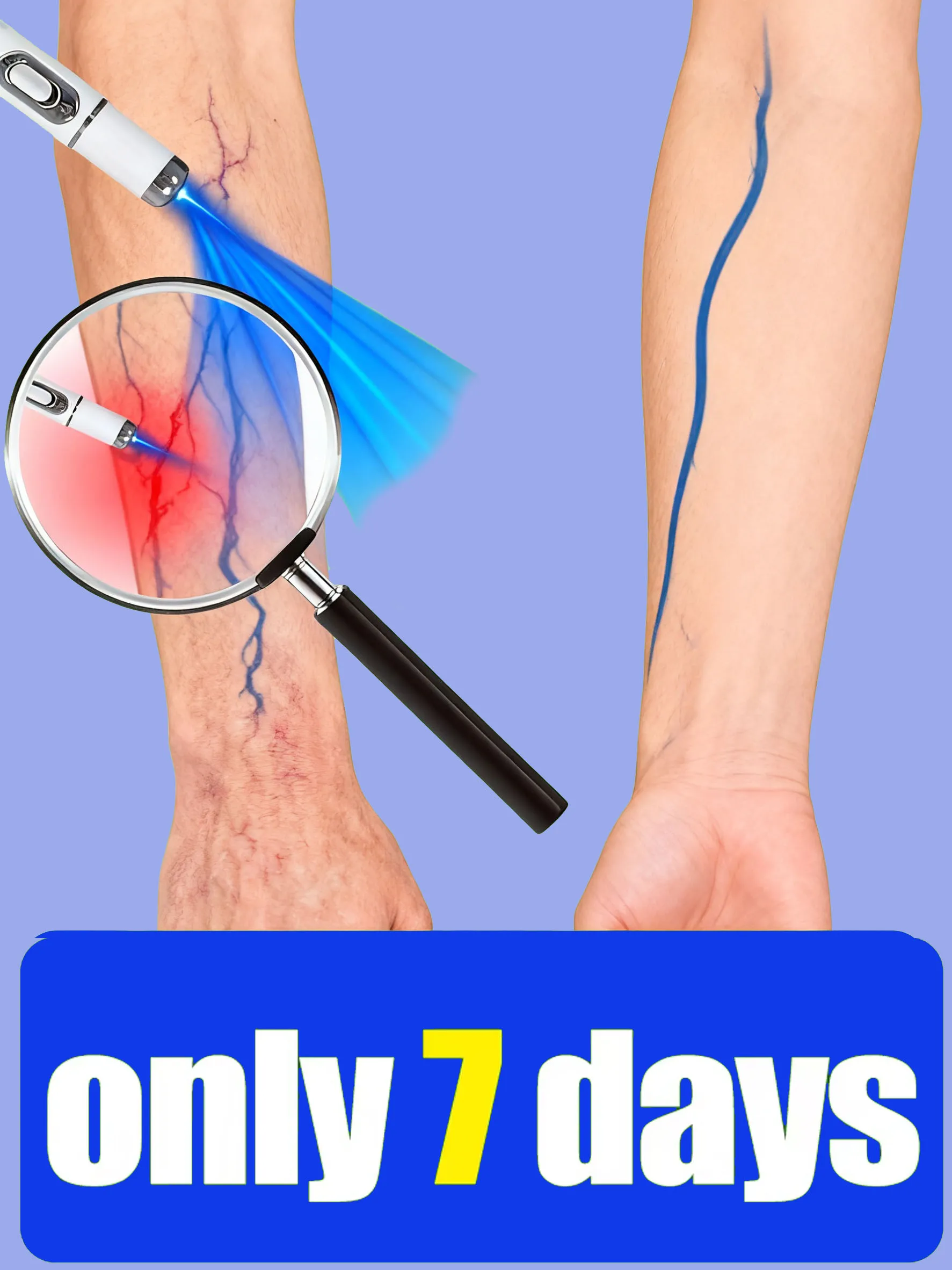 

New generation blue light laser pen, heat generating laser leg care tool says goodbye to leg discomfor