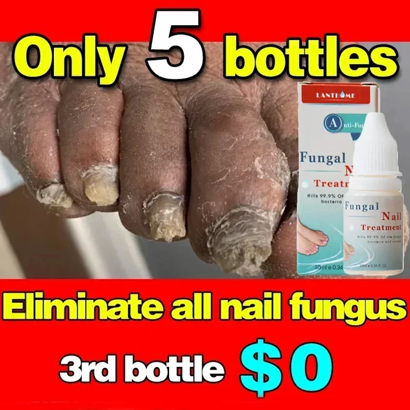 

Nail Fungals Renewal Nail Repair Liquid for Discolored Thickened Crumbled Nails Nail Fungals for Discolored Broken Cracked SF74