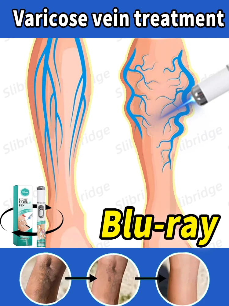 

Laser vein pen Remove varicose veins from the body