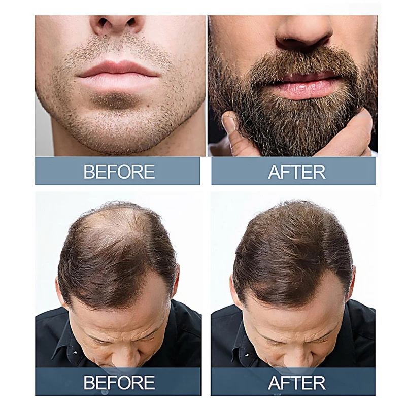 Tinh dầu chăm sóc tóc Nuôi dưỡng chân tóc Cải thiện sự phân chia thúc đẩy tăng trưởng